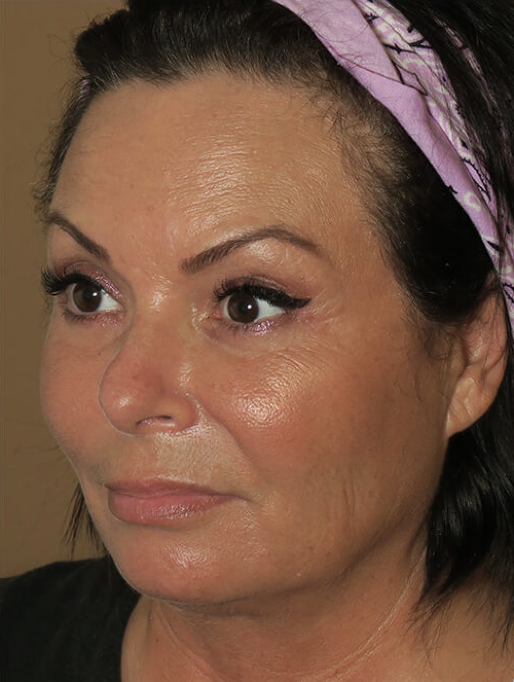 Buccal Fat Removal After, Female 46 - 4562