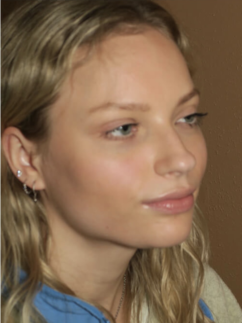 Buccal Fat Removal After, Female 24 - 4555