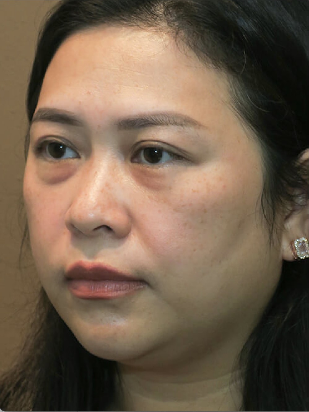 Buccal Fat Removal Before, Female 42 - 4559