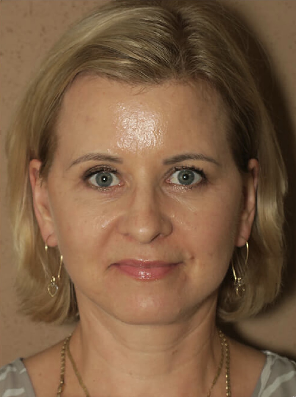 Buccal Fat Removal After, Female 53 - 4563