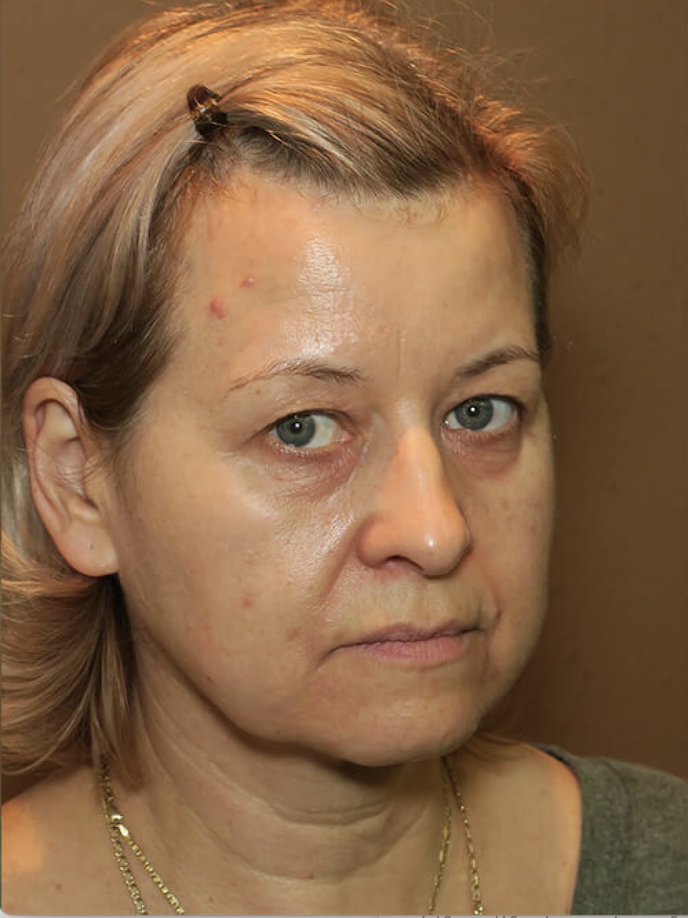 Buccal Fat Removal Before, Female 53 - 4564