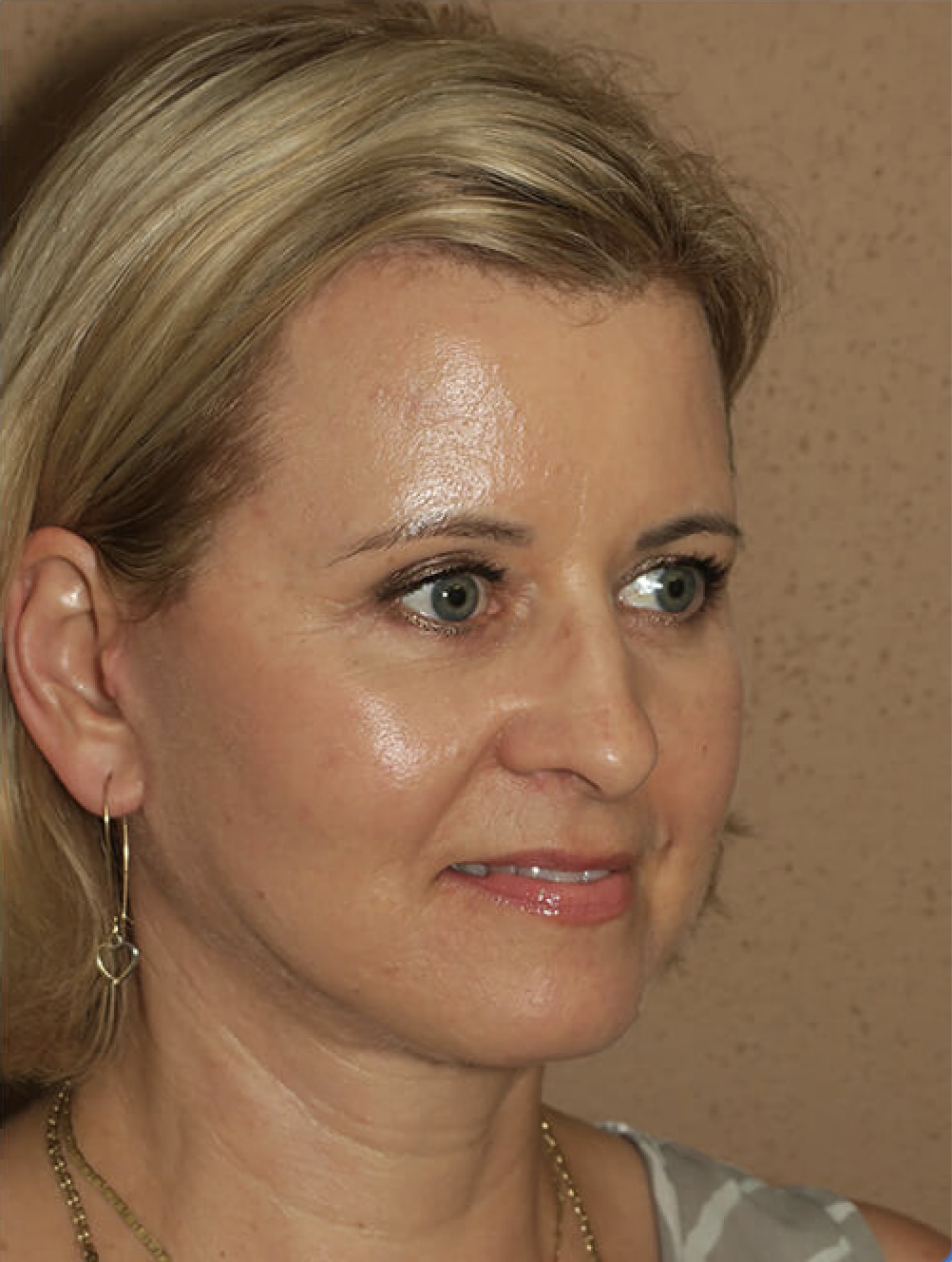 Buccal Fat Removal After, Female 53 - 4564