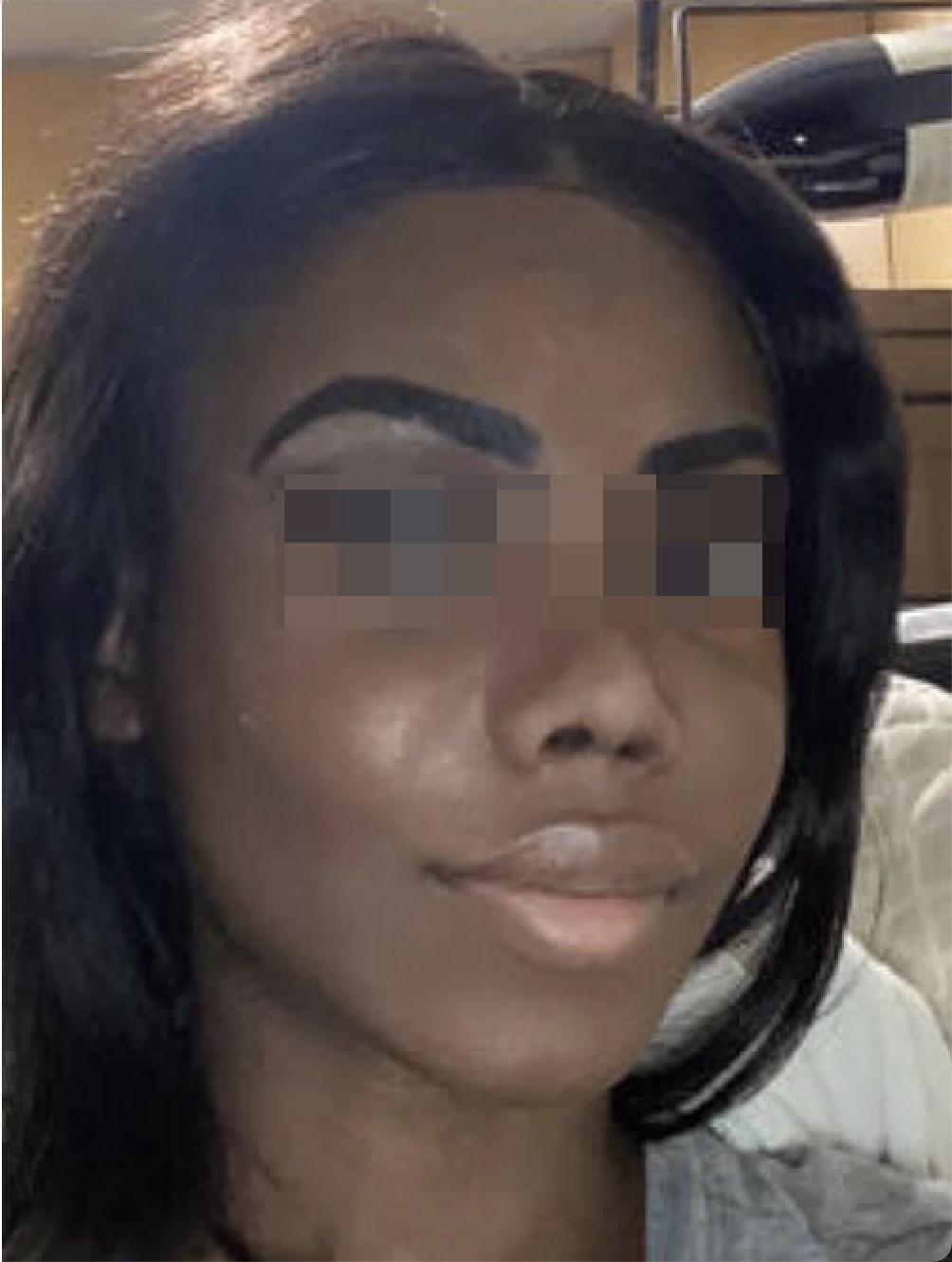 Buccal Fat Removal After, Female 37 - 4566