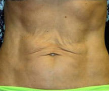 Laser Skin Resurfacing Before, Female 38 - 2085