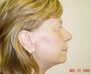 Facelift After, Female 59 - 1752