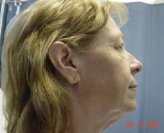 Facelift Before, Female 59 - 1752