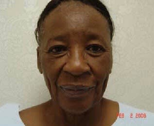 Facelift Before, Female 60 - 1753