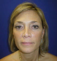 Facelift After, Female 46 - 1754