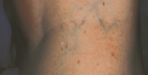 Vein Treatment Before, Female 41 - 2086