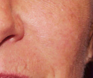 Vein Treatment After, Female 50 - 2087