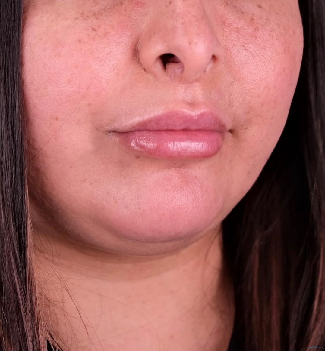 Subnasal 'Bullhorn' Lip Lift After, Female 34 - 2367