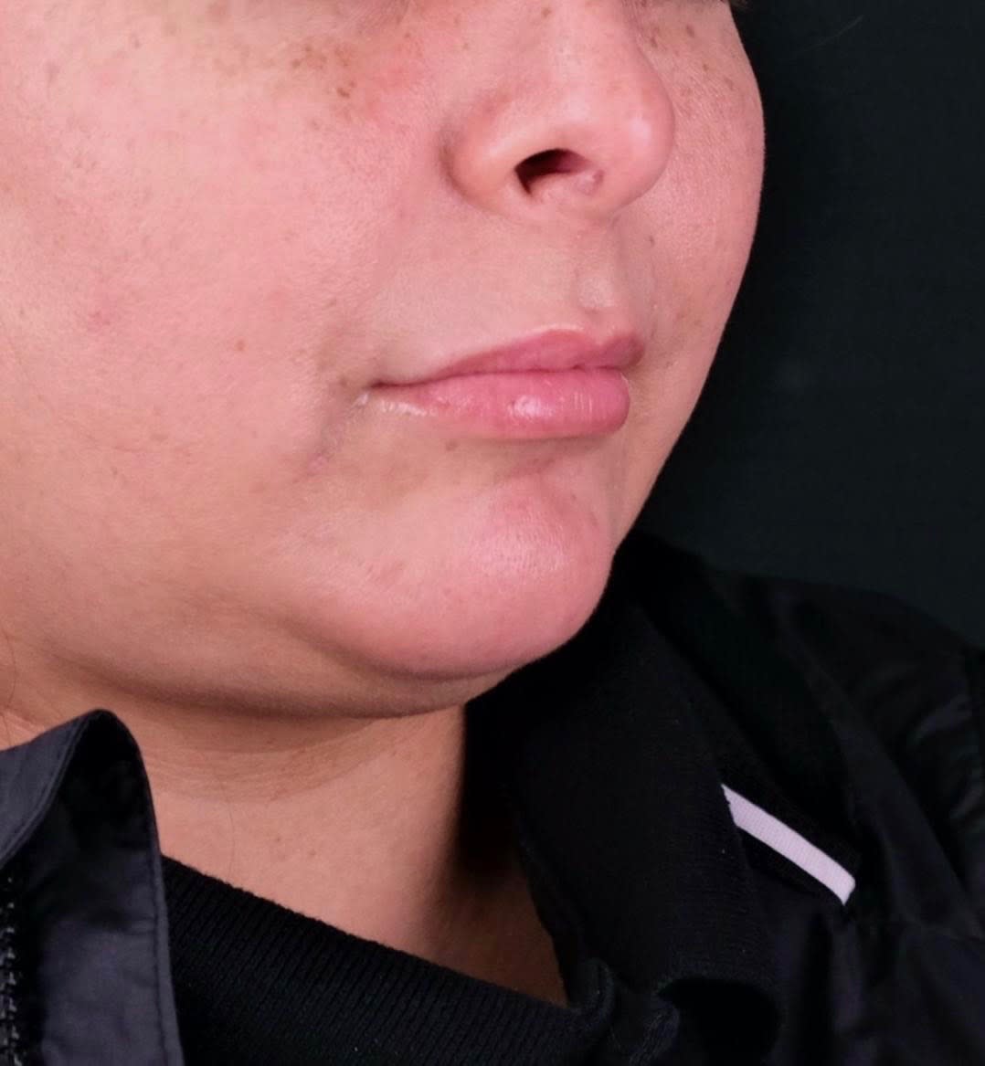 Subnasal 'Bullhorn' Lip Lift Before, Female 34 - 2367