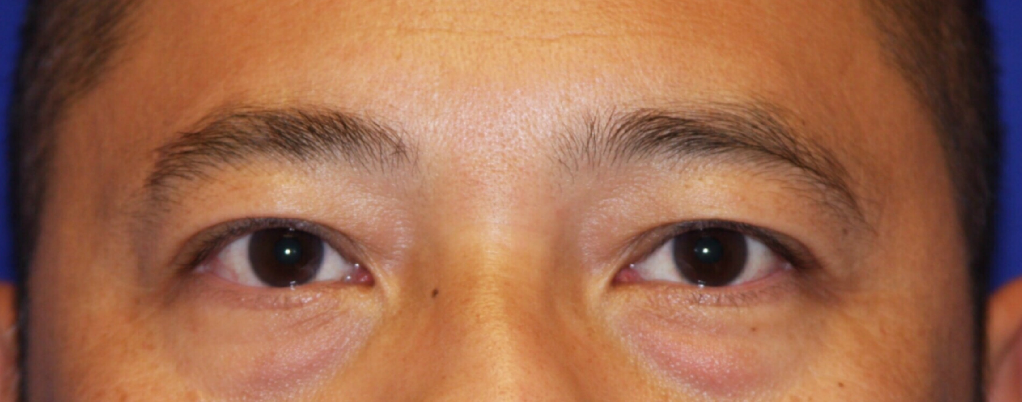 Blepharoplasty Before, Male 45 - 114