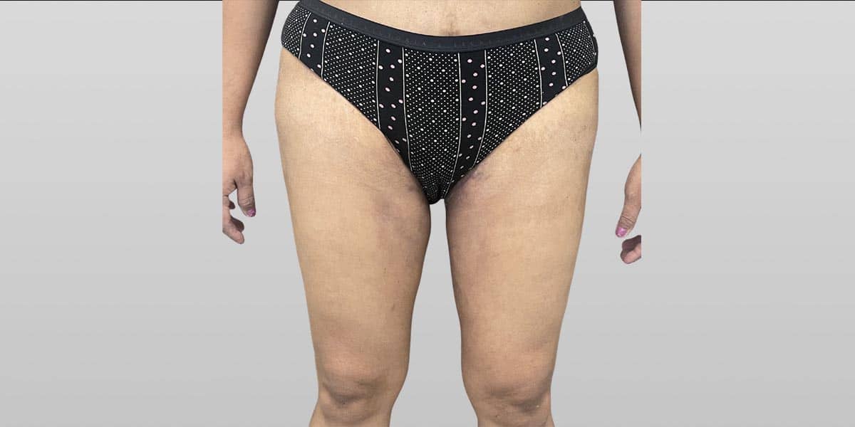 Thigh Lift After, Female 40 - 3948