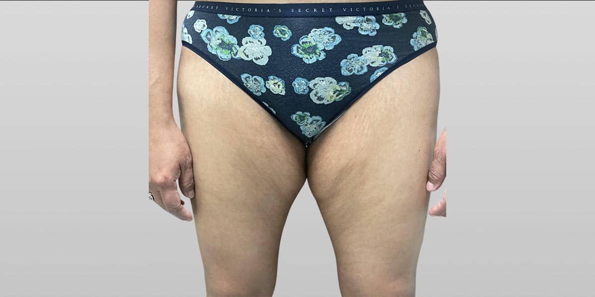 Thigh Lift Before, Female 40 - 3948