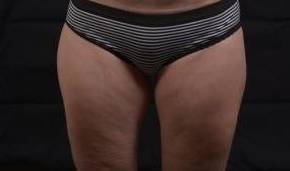 Thigh Slimming Solutions After, Female 47 - 1986