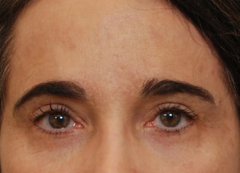 Blepharoplasty After, Female 55 - 21