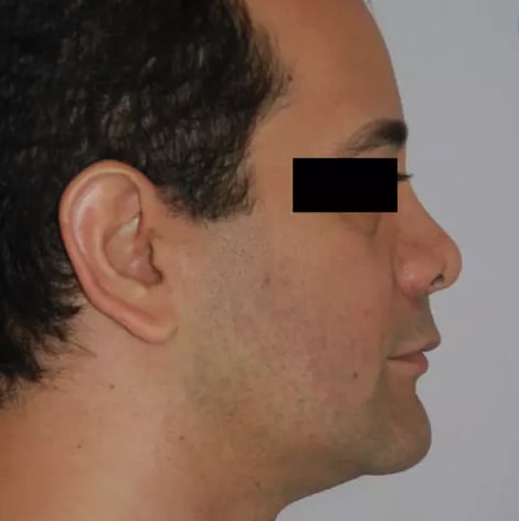 Revision Rhinoplasty Before, Male 40 - 2805
