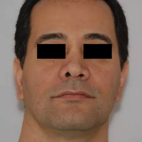 Revision Rhinoplasty Before, Male 40 - 2808