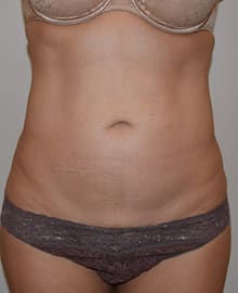 Abdominoplasty Before, Female 45 - 265