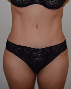 Abdominoplasty After, Female 45 - 265