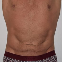 Abdominoplasty Before, Male 59 - 266