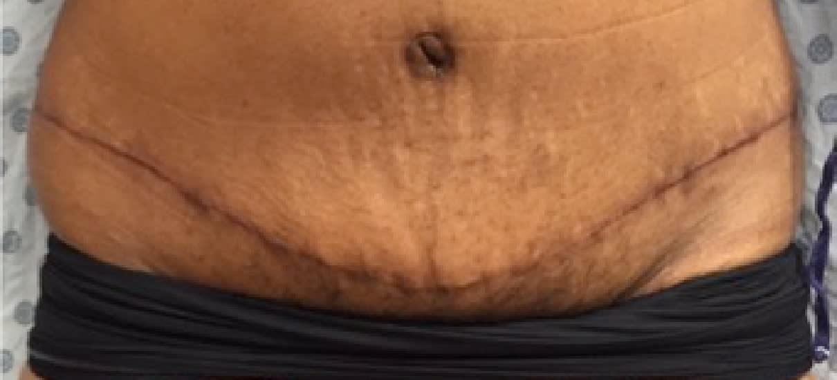 Abdominoplasty After, Female 35 - 1074