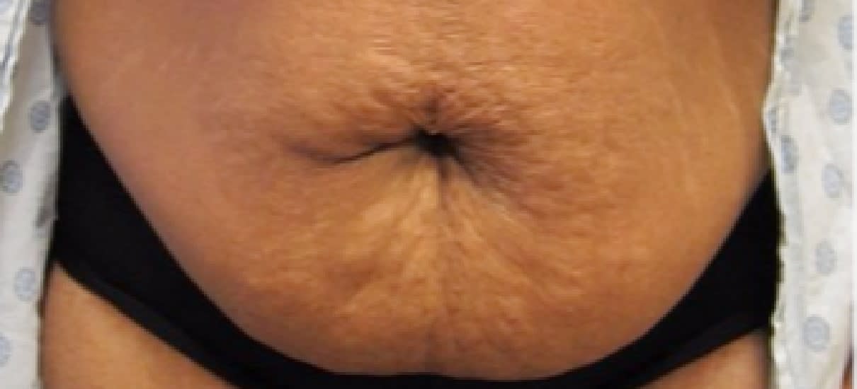 Abdominoplasty Before, Female 35 - 1074