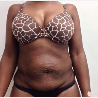 Tummy Tuck (Abdominoplasty) Before, Female 36 - 1666