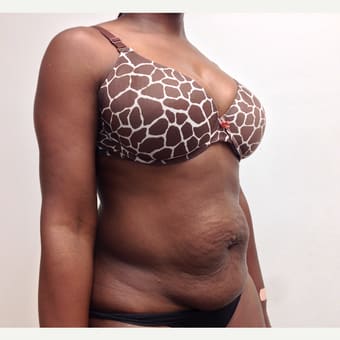 Tummy Tuck (Abdominoplasty) Before, Female 36 - 2058