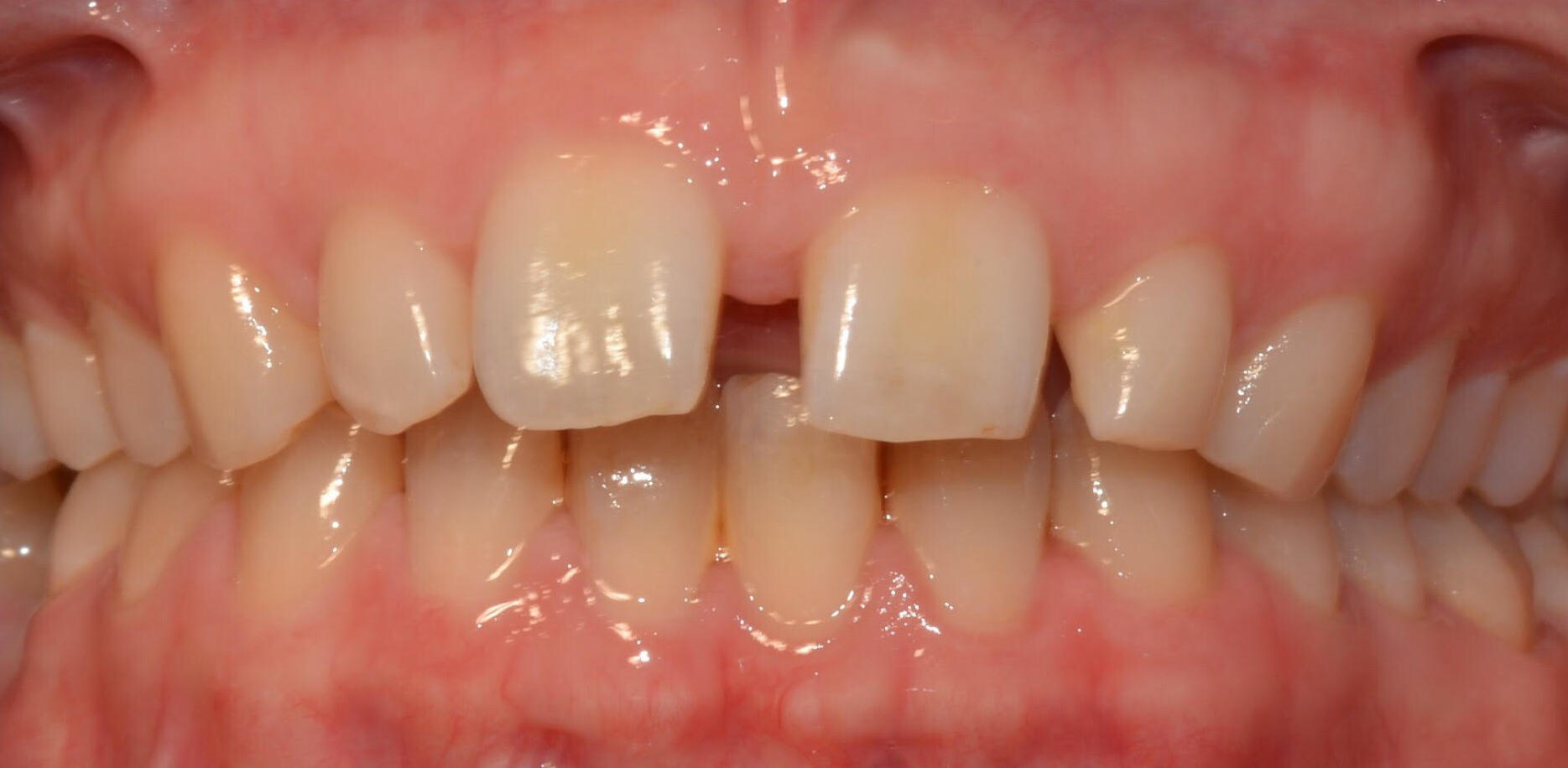 Dental Veneers Before, Female 29 - 9