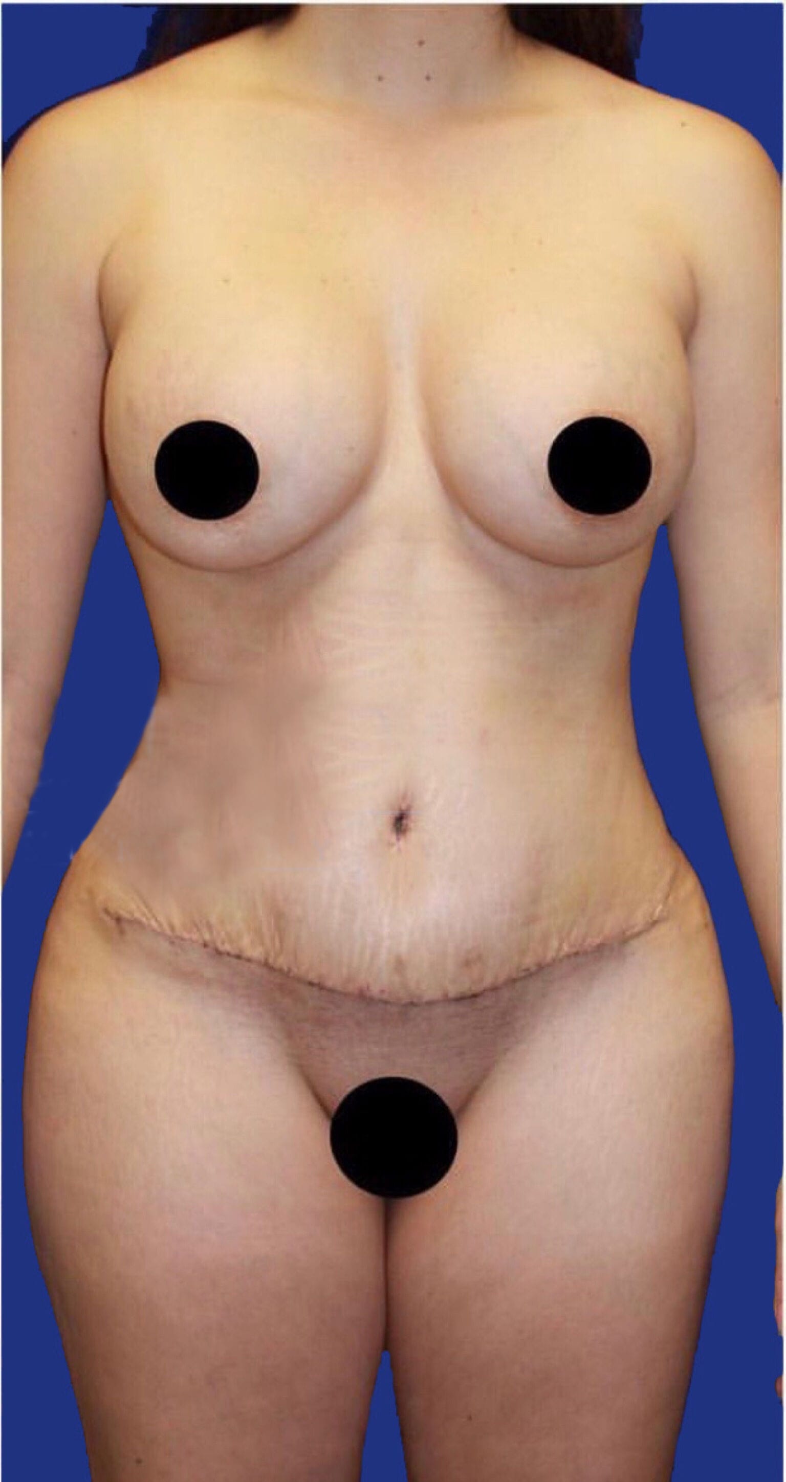 Tummy Tuck (Abdominoplasty) After, Female 35 - 116