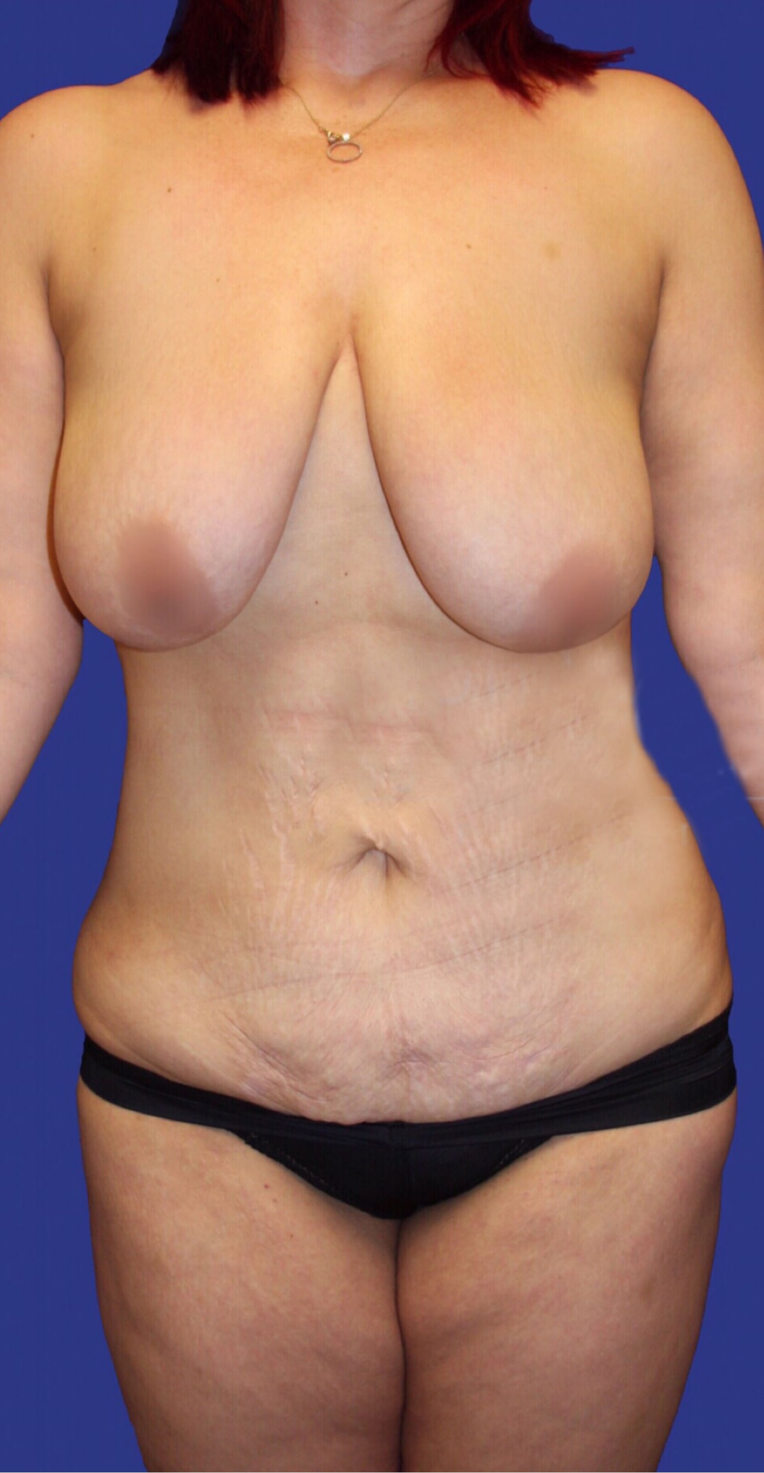 Tummy Tuck (Abdominoplasty) Before, Female 40 - 118