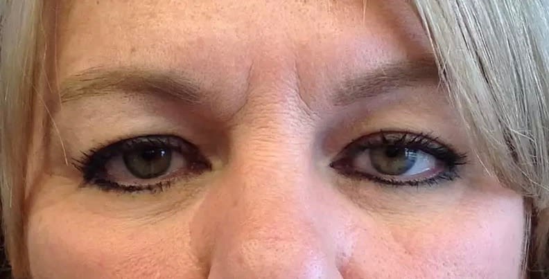 Blepharoplasty Before, Female 49 - 2834