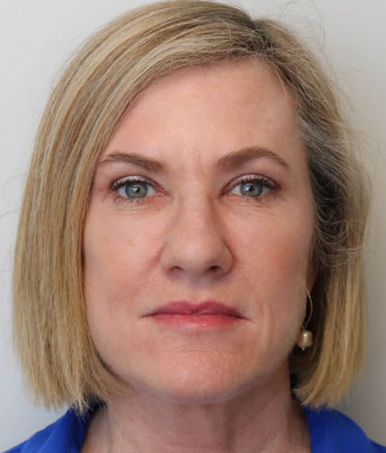 Upper Eyelid Blepharoplasty After, Female 51 - 2361