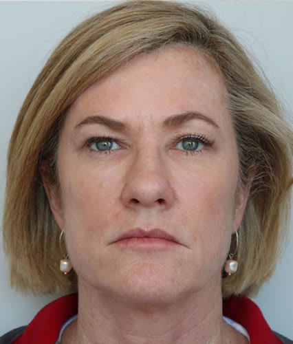 Upper Eyelid Blepharoplasty Before, Female 51 - 2361