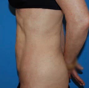 Liposuction After, Female 44 - 2915