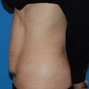 Liposuction Before, Female 44 - 2915