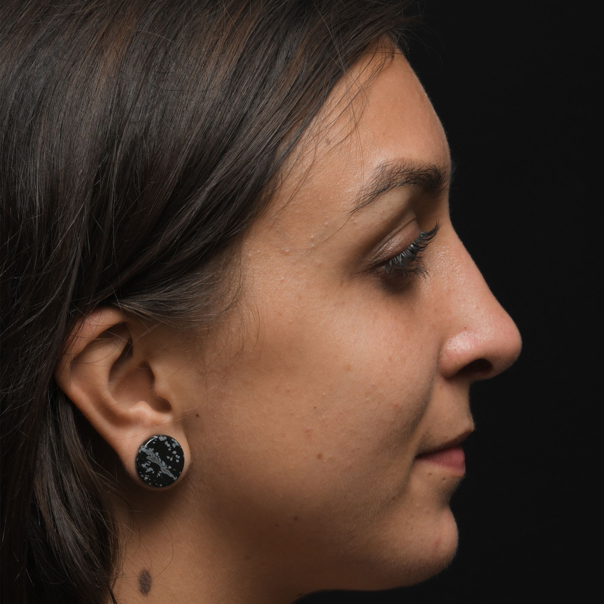 Chin Augmentation After, Female 22 - 49