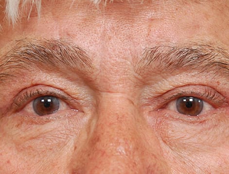 Blepharoplasty After, Male 75 - 18