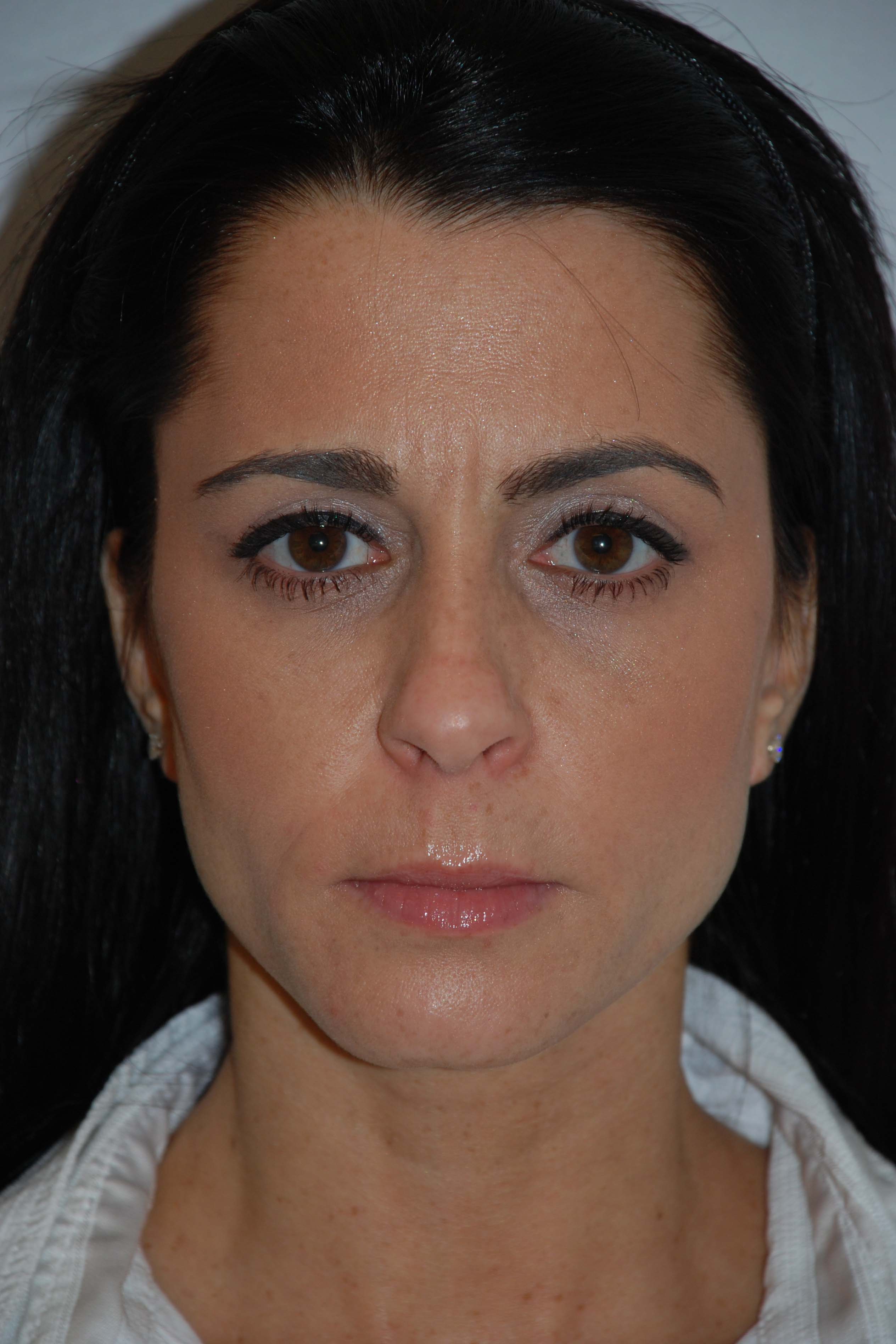 Blepharoplasty After, Female 41 - 7