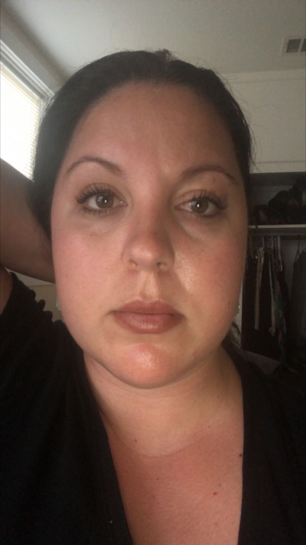 Abdominoplasty Before, Female 23 - 2