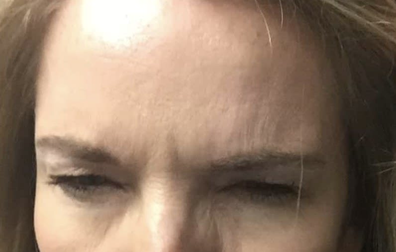 Xeomin® After, Female 50 - 4137