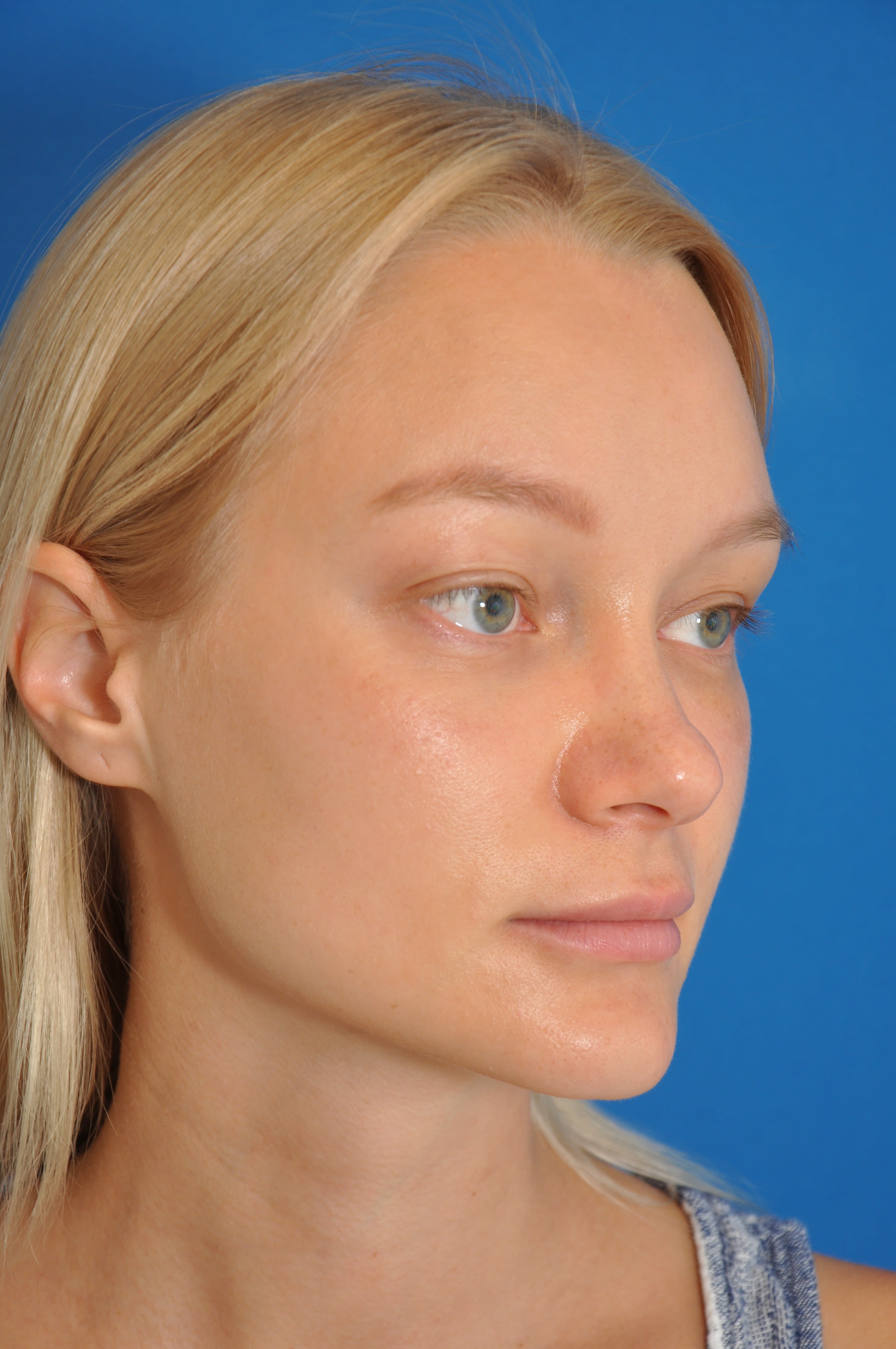 Brow Lift After, Female 25 - 1375