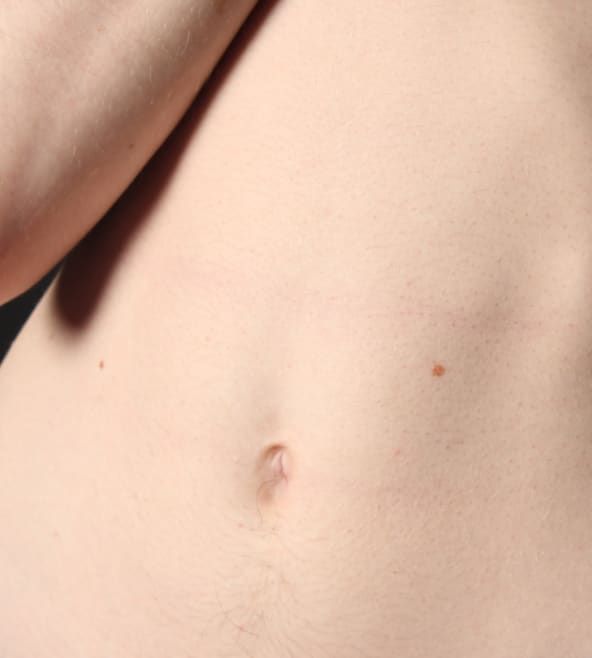 Belly button business: What's an umbilical hernia and does it need