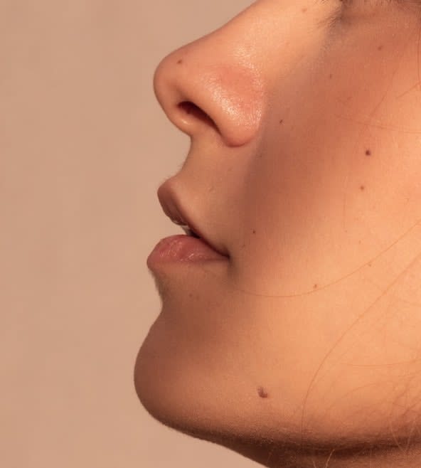 Lip Reduction Surgery (Overview) Overview - 925