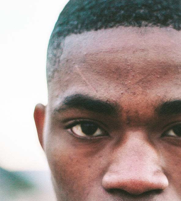 ZPlasty Scar Revision Overview Cost, Recovery, Before & After AEDIT