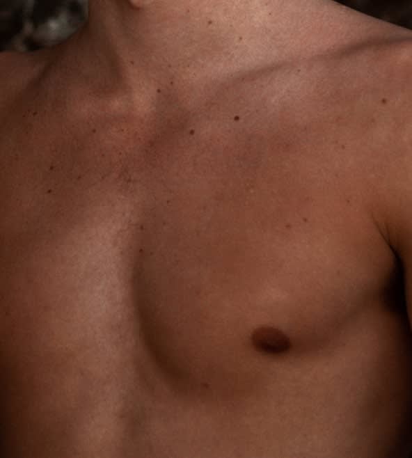 Nipple Correction Solutions Overview - 1137