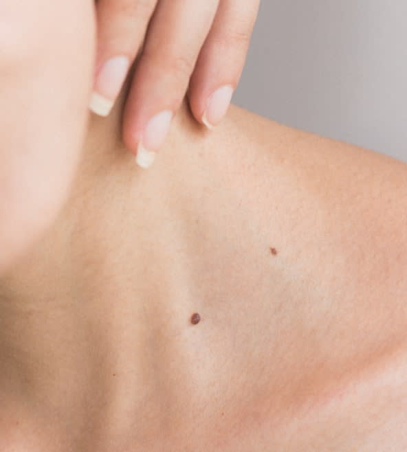 Birthmark, Mole, & Skin Growth Removal Solutions Overview - 1106