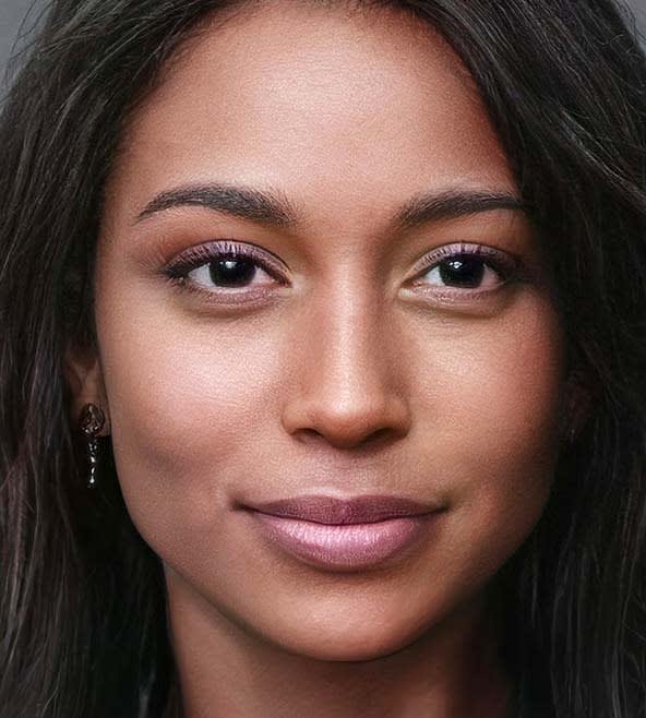 Radiesse® Overview - 1164